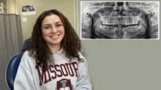 Dolgu yaptırmak isterken çenesinden kist çıktı