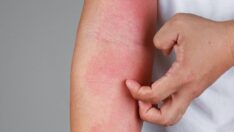 ‘Pandemide uyuz vakaları yüzde 50 arttı’