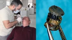 Yanağına saplanan metal parçasıyla 15 yıl yaşadı