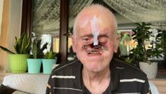 Burnu her gün milim milim eridi