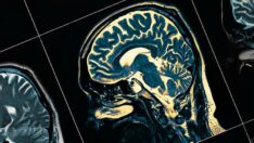 Japon bilim insanlarından Alzheimer tedavisinde umut olacak çalışma