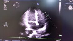 Corona virüsü hastalarında kalp kasılma fonksiyonları düşük çıktı