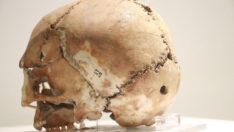 Dünyanın ilk beyin ameliyatı 10 bin 500 yıl önce Aksaray’da yapıldı
