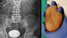 Hastanın mesanesinden çıktı! Doktorlar bile şaşırdı