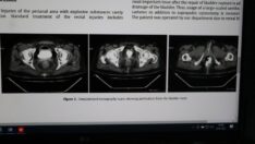 Makatına torpil yerleştirip patlatan kişi, tıp literatürüne girdi