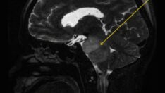 Tam 4 aydır hiç durmadan hıçkırıyor: Uzmanlar nedenini bulmuş olabilir