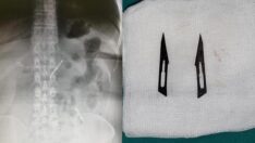 Karın ağrısı şikayetiyle gitti, midesinden çıkanlara o da şaşırdı