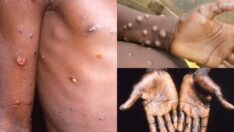 Avrupa’da maymun çiçeği salgını paniği: Eşcinsel festivali ile ilgili soruşturma başlatıldı