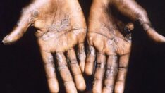 CHP’den Maymun Çiçeği açıklaması