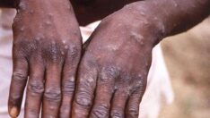 DSÖ’den maymun çiçeği virüsü için mutasyon açıklaması