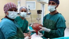 Karnından 3 kiloluk kitle çıkartıldı