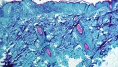 Maymun çiçeği hastalığı uyarısı: Cinsel hayatınızda bu alışkanlık varsa…