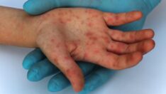 Maymun çiçeği ve zona arasındaki farkları biliyor musunuz?