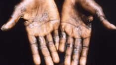 Maymun çiçeği virüsüyle ilgili komplo teorileri neler?