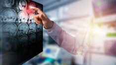 Prof. Dr. Özlem Kayım: Her yıl 17 milyon insan inme geçiriyor