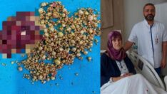 76 yaşındaki hastanın safra kesesinden bin 284 taş çıktı