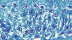 Berlin’de maymun çiçeği patlaması: 9 kişi hastanelik oldu