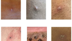 Dünya Sağlık Örgütü’nden maymun çiçeği virüsü (monkeypox) için 3 uyarı