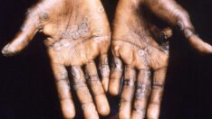 Türkiye’de maymun çiçeği tespit edildi