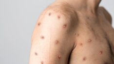 Ülkede maymun çiçeği hastalığı tespit edilen ilk hasta konuştu