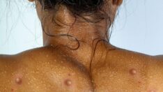 Ünlü sağlık kuruluşu maymun çiçeğinden korunarak nasıl seks yapılacağını rehberle anlattı