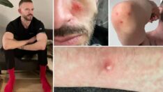 Maymun çiçeği hastası konuştu: Acıdan çığlık atıyorum