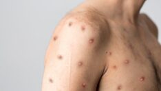 Türkiye’de de hasta tespit edilmişti: Endişe yaratan maymun çiçeği açıklaması