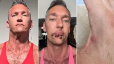 Türkiye’de görülen maymun çiçeği bulaşan adam yaşadıklarını anlattı