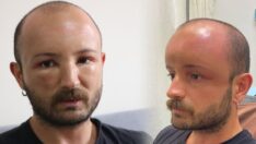 2 gün üst üste plaja gitti bu hale geldi