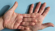 Amerika’da maymun çiçeği hastalığına yakalanan kadın konuştu: Acı vericiydi