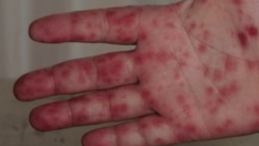 Covid ve maymun çiçeğinden sonra yeni bir salgın daha: Domates gribi