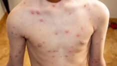 DSÖ, maymun çiçeği virüsünün ismini değiştirecek: Önerileri bekliyoruz