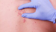 Herpes virüsü ve Tip 2 diyabet arasındaki ilişki açığa çıktı