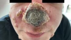 Korkunç görüntü: Maymun çiçeği bulaşan adamın burnu çürümeye başladı