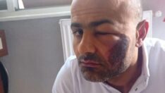 Lazer epilasyon sonrası ‘yanık’ suçlaması