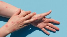 Maymun çiçeği ile ilgili korkutan araştırma: Enfekte kişilerin dokunduğu alanlara dikkat!