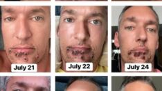 Maymun çiçeğine yakalanan adam günlük belirtileri gözler önüne serdi