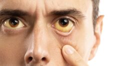 Sarı humma hastalığı nedir, belirtileri neler?