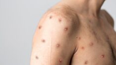 Uzmanlar uyardı: Maymun çiçeğinde hiç bilinmeyen yeni semptomlar