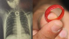 Yerde buluğu yüzüğü yutan 3 yaşındaki çocuk ölümden döndü