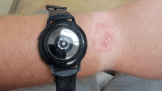 Akıllı saat kullanıcısından şoke eden iddia: Uyurken bileğini yaktı