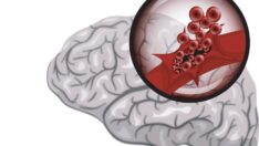 Felç nasıl anlaşılır