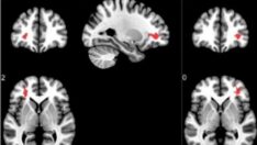 Covid-19 geçirenlerin beyinlerini incelediler: Endişe yaratan sonuç