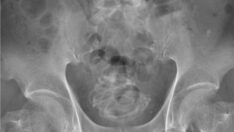 Doktorlar şaştı kaldı: Cinsel organından 2 metrelik ip çıkardılar