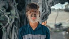 Dünyanın en tuhaf hastalıklarından birine sahip: Yaşayan ‘Kurt Adam’