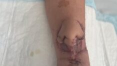 Fransa’da çığır açan tedavi: Burnu kolunda yeniden çıktı