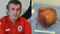 Göğsünden çıkan kitle doktorları da hayrete düşürdü