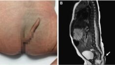 İnanılmaz olay: 6 cm kuyrukla dünyaya geldi