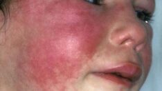 İngiltere’de kızıl paniği: Ölümcül hastalık yıllar sonra hortladı