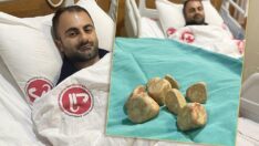 Mesanesinden yarım kilo taş çıkarıldı